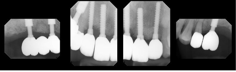 審美歯科症例紹介1・xray・アイティデンタル日暮里