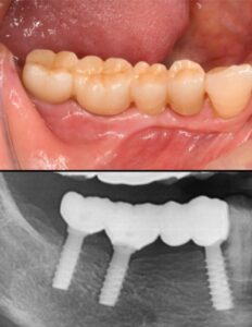 インプラント症例紹介・手術後の写真と・レントゲンの写真