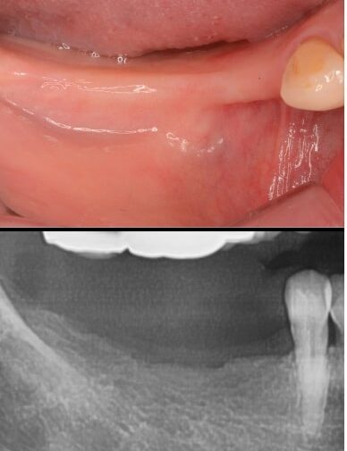 インプラント症例紹介・手術前の写真と・レントゲンの写真