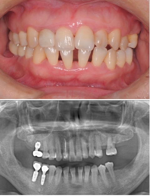歯周病治療の症例（終了時）　しっかりと噛めるようになって笑顔を取り戻しました
