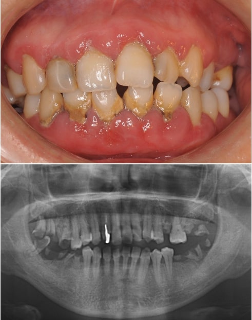 歯周病治療 の症例　初診時の写真とレントゲン