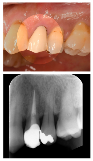 インプラント症例紹介・手術前後の写真とレントゲンの写真・インプラント症例写真