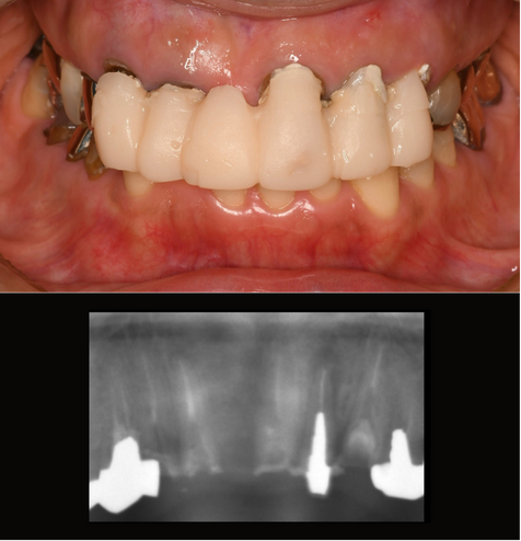 インプラント症例紹介・手術前後の写真とレントゲンの写真・インプラント症例写真