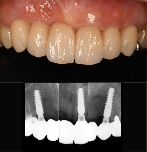 インプラント症例紹介・手術前後の写真とレントゲンの写真・インプラント症例写真
