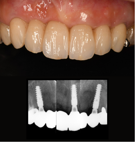 インプラント症例紹介・手術前後の写真とレントゲンの写真・インプラント症例写真