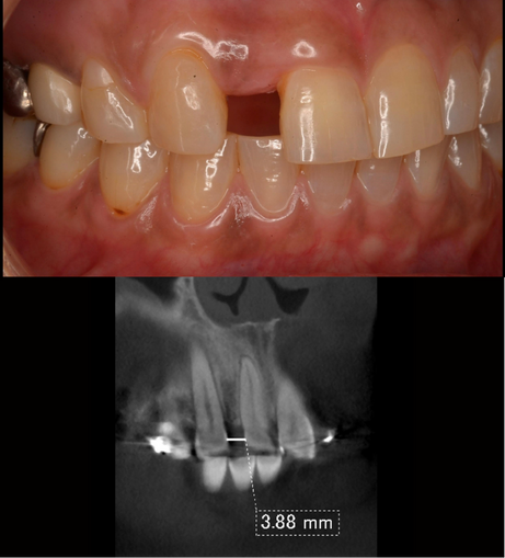 先天性欠如症例紹介・手術前後の写真・レントゲンの写真・インプラント症例紹介
