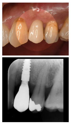 インプラント症例紹介・手術前後の写真とレントゲンの写真・インプラント症例写真