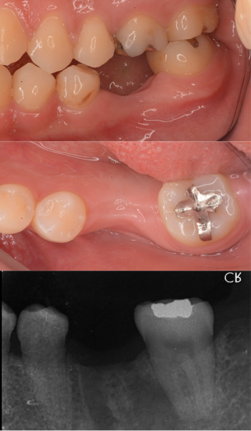 インプラント症例紹介・手術前後の写真とレントゲンの写真・インプラント症例写真