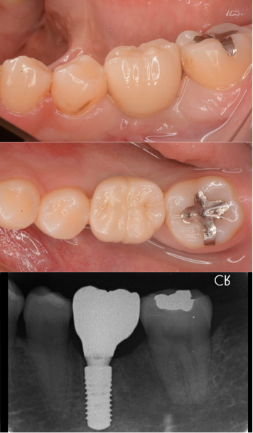 インプラント症例紹介・手術前後の写真とレントゲンの写真・インプラント症例写真