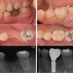インプラント症例紹介・手術前後の写真とレントゲンの写真・インプラント症例写真