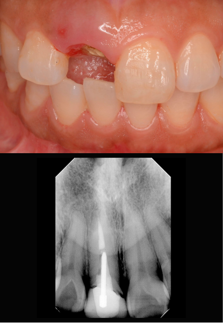 インプラント症例紹介・手術前後の写真とレントゲンの写真・インプラント症例写真