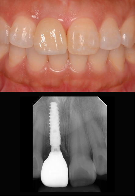 インプラント症例紹介・手術前後の写真とレントゲンの写真・インプラント症例写真