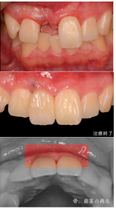 インプラント症例紹介・手術前後の写真とレントゲンの写真・インプラント症例写真