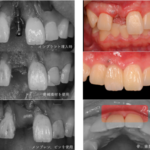 インプラント症例紹介・手術前後の写真とレントゲンの写真・インプラント症例写真