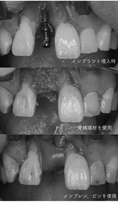 インプラント症例紹介・手術前後の写真とレントゲンの写真・インプラント症例写真